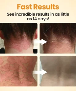Medazy® BeeLieve Psoriasis Skin Care