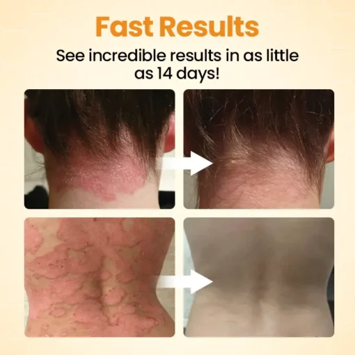 Medazy® BeeLieve Psoriasis Skin Care