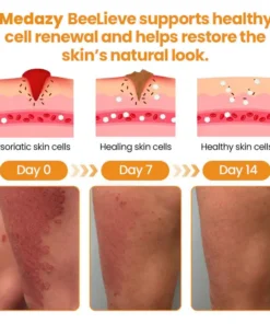 Medazy® BeeLieve Psoriasis Skin Care