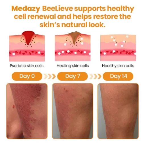 Medazy® BeeLieve Psoriasis Skin Care