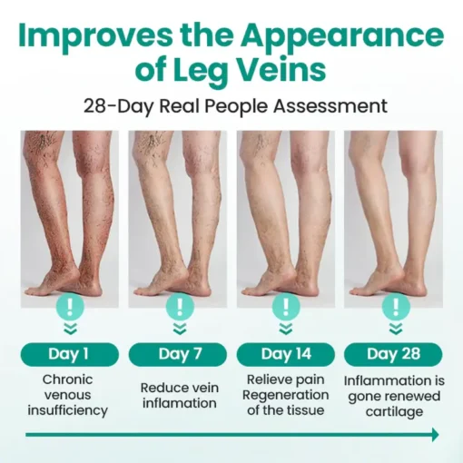 TMRelieve® Legrenew Varicose Veins Patch