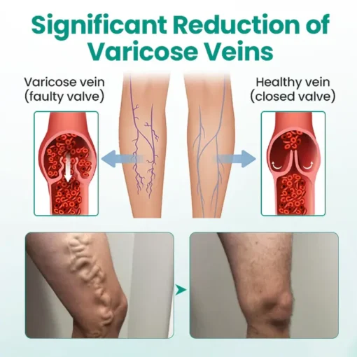 TMRelieve® Legrenew Varicose Veins Patch